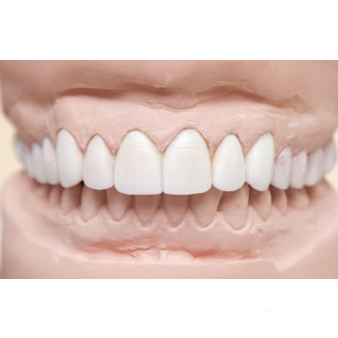 Dental Veneers in Dubai | Hollywood smile makeover