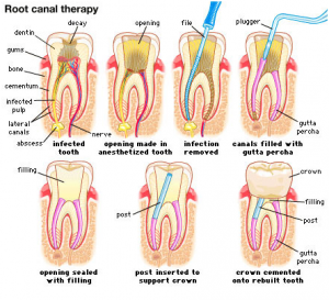 Root Canal Treatment