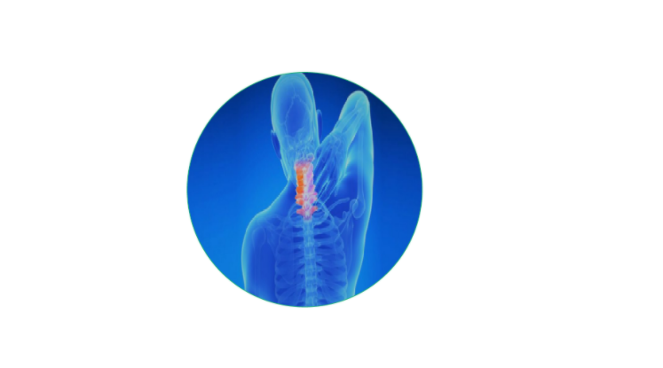 Homeopathy treatment for Cervical Spondylitis in Dubai