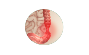 Irritable Bowel Syndrome