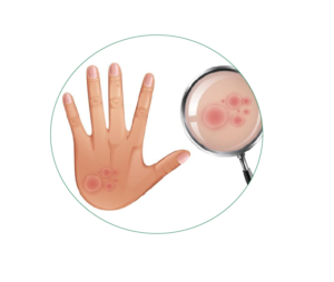 Lichen Planus