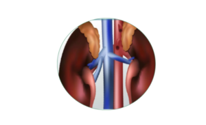 Nephrotic Syndrome