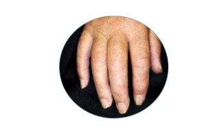 Psoriatic Arthritis