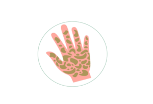 Psoriasis
