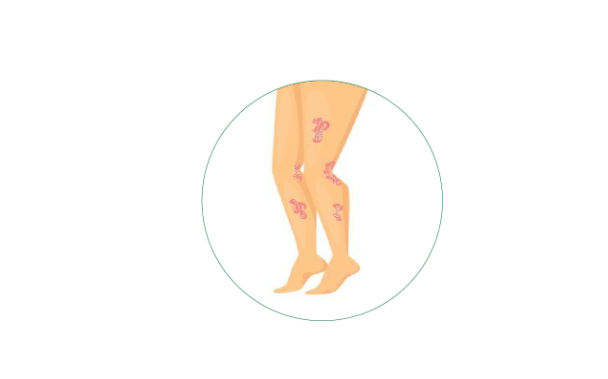 Homeopathy for Urticaria