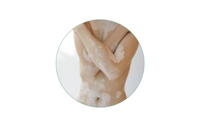 Homeopathy treatment for Vitiligo in Dubai