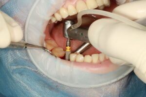 Implantology